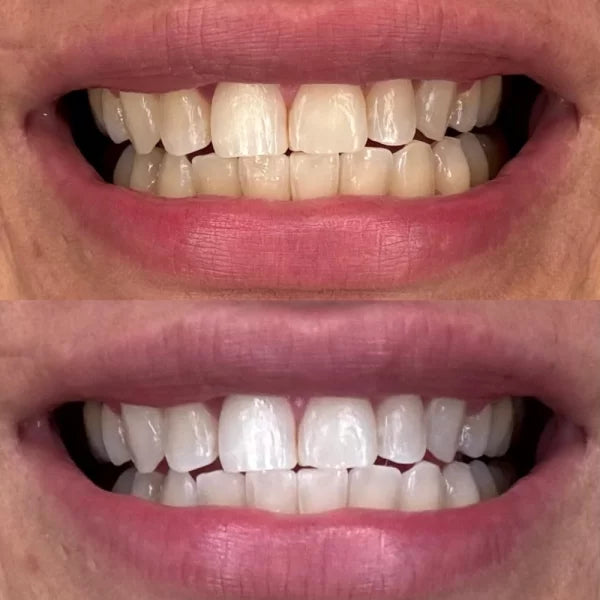 Crest 3D Whitestrips Luxe Professional Effects – 1 Sachet (1 Upper + 1 Lower Strip)